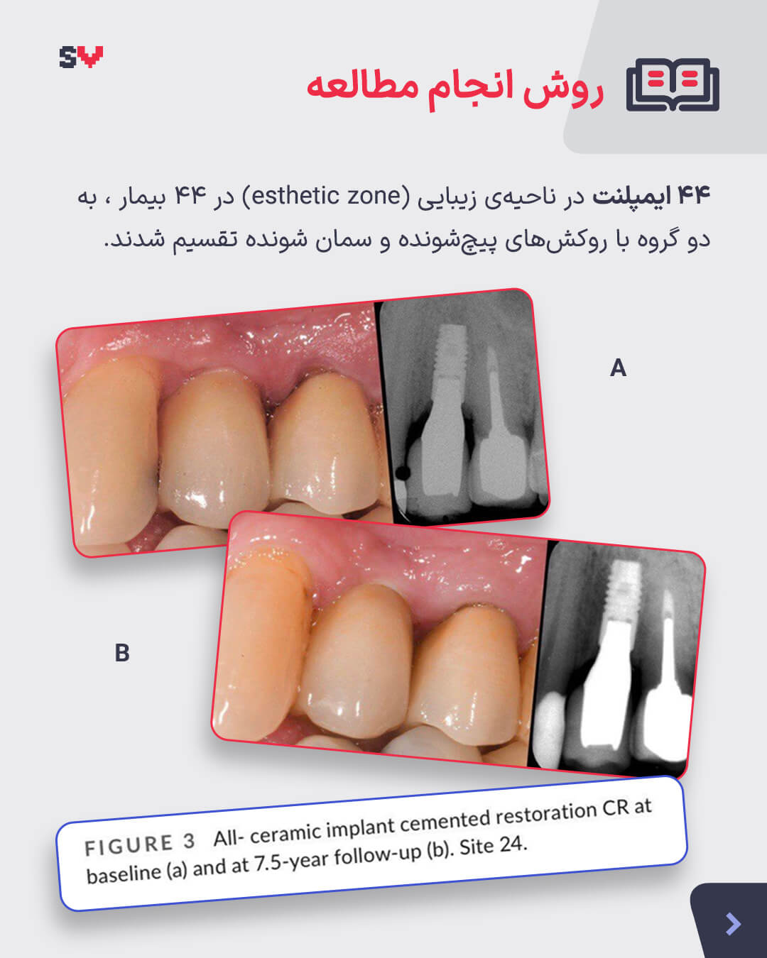 خلاصه مقاله مقایسه روکش ایمپلنت 